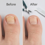 TrimEase - Angled Toenail Clippers for Thick Nails
